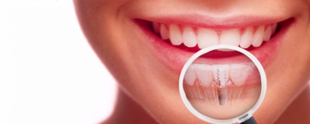 Prevenção de Complicações em Implantes Dentários: A Importância da Higiene