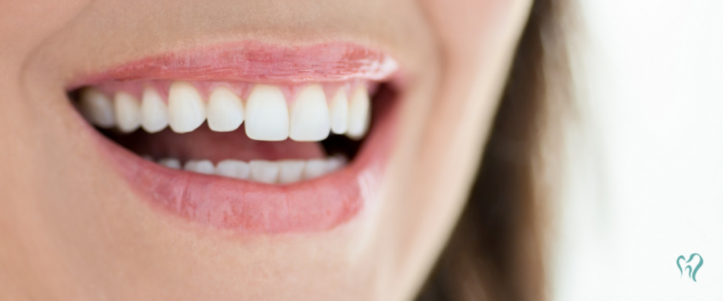 Implantes Dentários: Como Manter uma Higiene Bucal Impecável