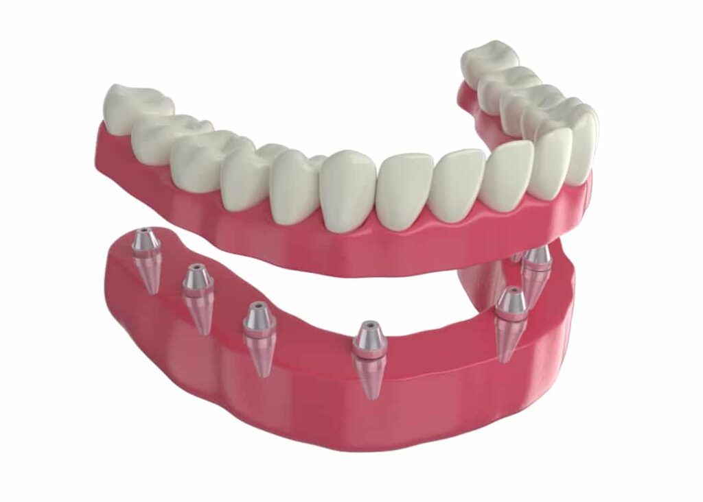 Implantes Dentários e Saúde Bucal