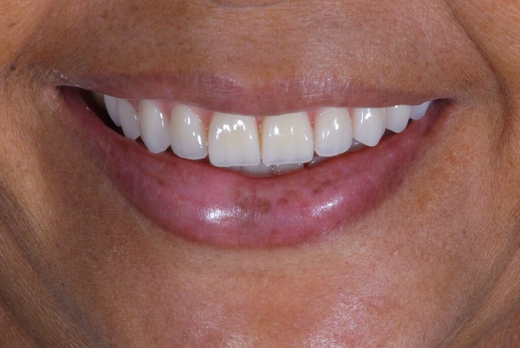 Inovações em Implantes Dentários