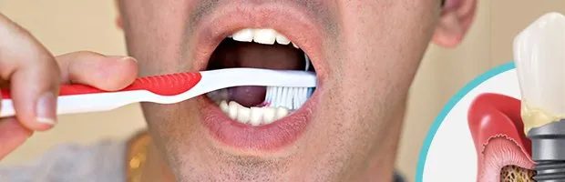 Hábitos de Higiene Bucal para Garantir o Sucesso dos Implantes